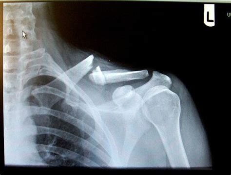 X Rays Of Broken Bones Lance Armstrongs Broken Collarbone Ouch