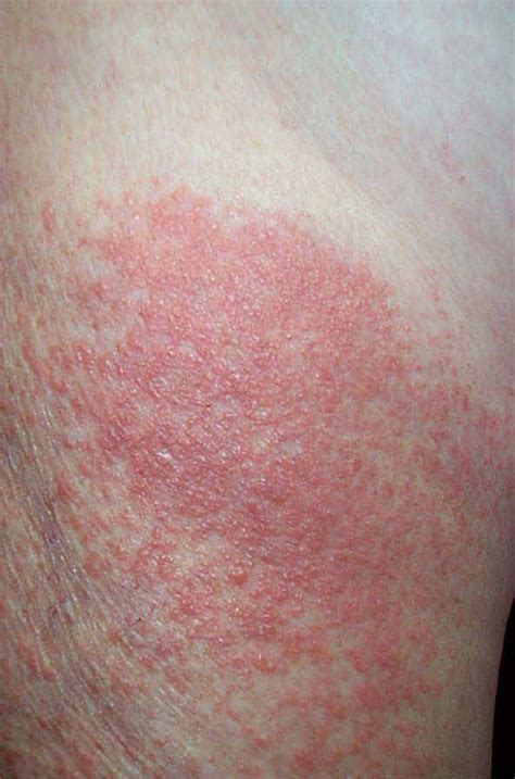 Polymorphic Light Eruption Lightallergy Uvallergy Skinrash