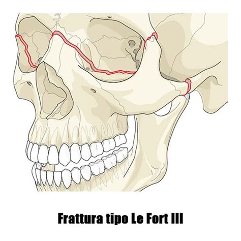Fratture del mascellare - Le Fort I - II - III.