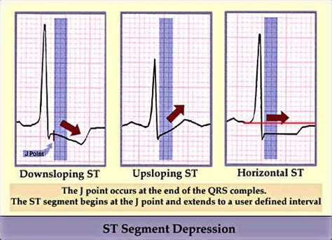 Simple Cardiology Types Of St Segment Depression In Ecg