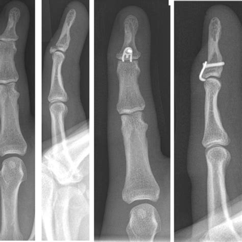 A Distal Phalanx Fracture With Dislocation And The Postoperative X Ray
