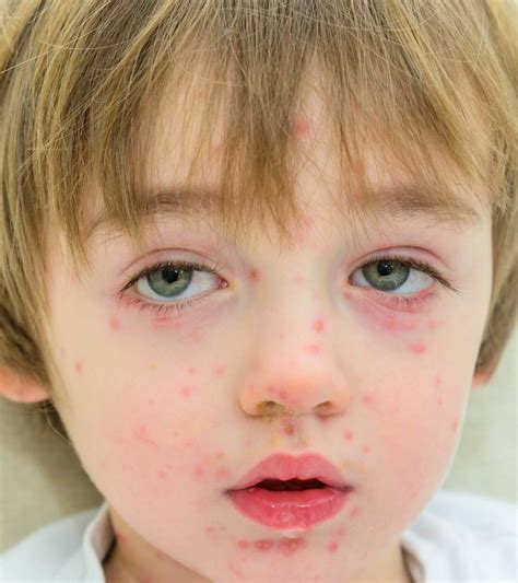 Papular Urticaria In Children Causes Symptoms And Treatment