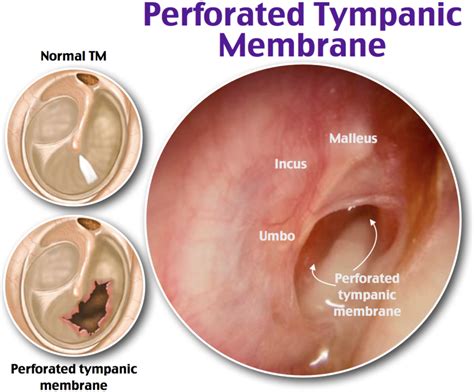 Perforated Tympanic Membrane Medical Surgical Nursing Pediatric My