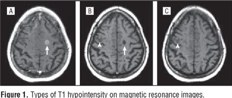 Figure 1 From Magnetic Resonance Techniques In Multiple Sclerosis The Present And The Future