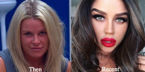 Skye Wheatley Plastic Surgery Before And After Photos Latest Plastic Surgery Gossip And News