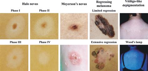 Immune Reactions In Benign And Malignant Melanocytic Lesions Lessons