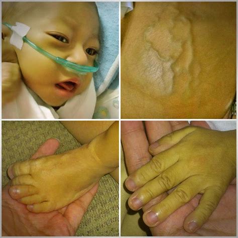 It can be congenital or acquired. A Matter of life and Breath