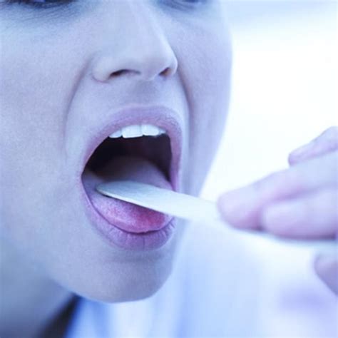 Symptoms Of Tonsil Cancer