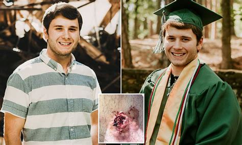 It's most prevalent in black men who ingrown hairs most commonly appear in the beard area, including the chin and cheeks and. Nursing student, 21, with incurable cancer mistook his ...