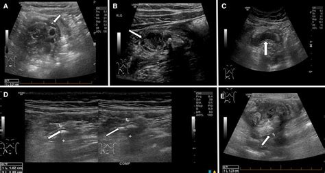 Ultrasound Imaging Of The Appendix A Category 1 Us Normal Appendix