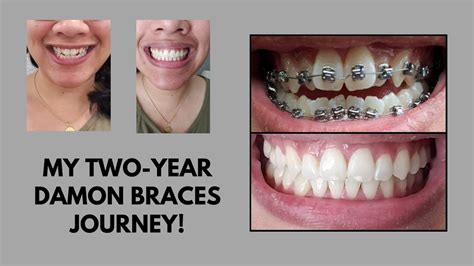 Comprehensive Damon Braces Video Full Two Year Process W Updates