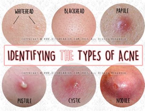 Types of acne with pictures and treatment. DIFFERENT TYPES OF ACNE - ALL ABOUT ACNE