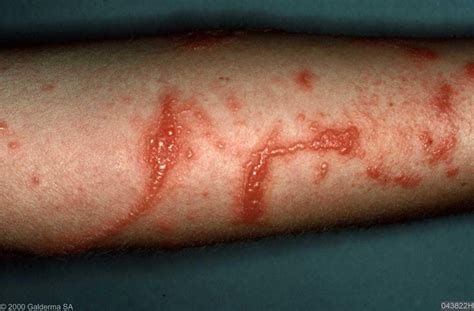 Archive Of Standardized Exam Questions Contact Dermatitis Stepwards