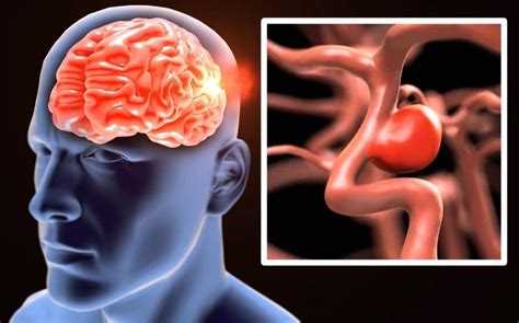 Aneurisma Cerebral O Que E