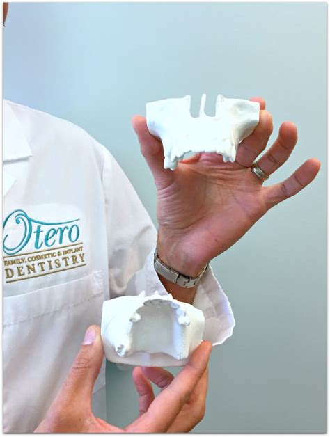 Dental Bone Graft Dental Implants Wilmington Nc Hampstead