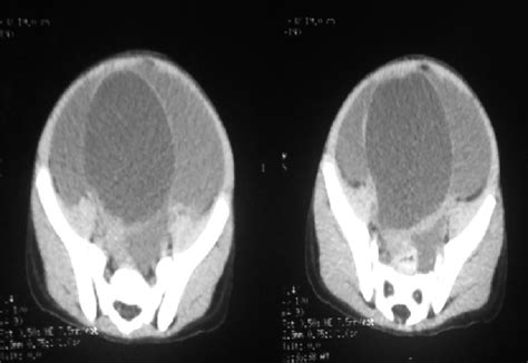 Whole Abdominal Ct Scan Of The Abdomen Showing Multiloculated Cystic