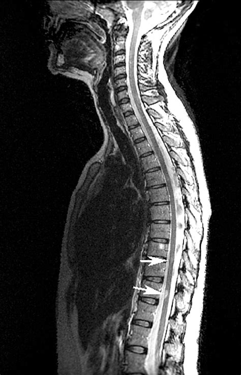 Spinal Cord Mri In Clinically Isolated Optic Neuritis Journal Of