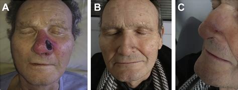 Sverzhevskiy scientific research institute for ear, nose, and throat diseases, moscow. On the Nose: Disseminated Mucormycosis - The American ...