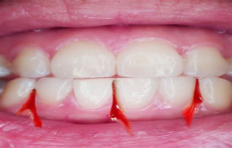 Bleeding Gums The Facts Shandon Dental Cork Dentist Blog