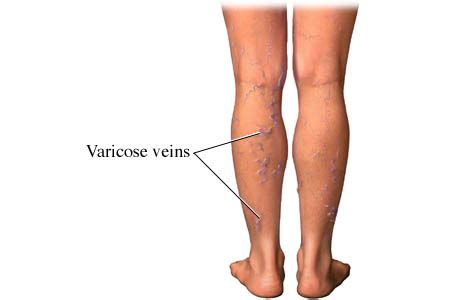 Varicose veins, also known as varicoses, are a medical condition in which superficial veins become enlarged and twisted. Varicose Veins During Pregnancy - New Kids Center