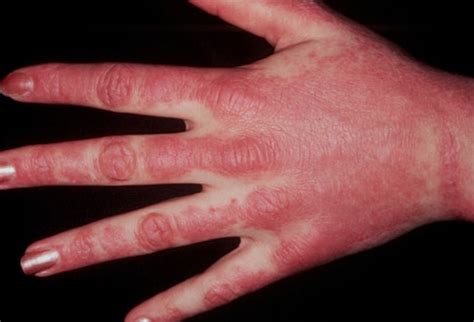 Abnormal Findings On The Hands Clues To Systemic Disease