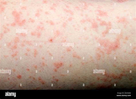 Rash Of Red Spots On The Skin Of A 5 Year Old Girl An Urticarial