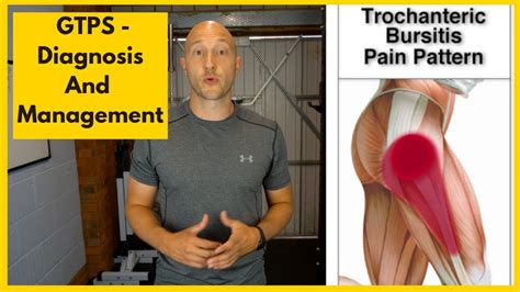Trochanteric Bursitis Pain Pattern