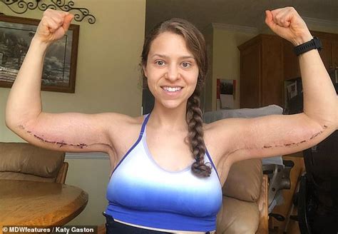 Woman Has 24 Inch Scars On Her Arms After Weight Loss Surgery Daily