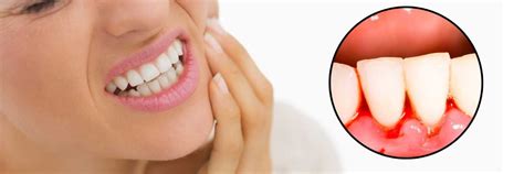 Gum Bleeding Treatment In Dubai Euromed® Clinic