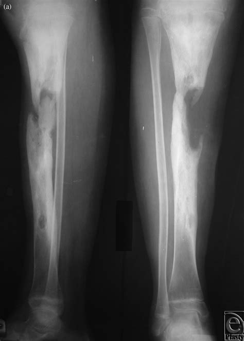 Case 3 Osteomyelitis Of The Lower Leg A Preoperative X Ray B