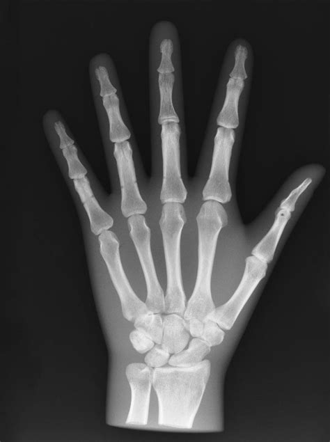 X Ray Phantom Hand Opaque Australian Physiotherapy Equipment
