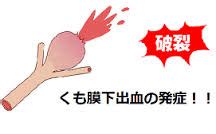 全身の症状 腹部と消化器の症状 出血 脳と神経系の症状 胸部と呼吸器系の症状. くも膜下出血や脳梗塞、脳出血と脂質異常症の関係について ...