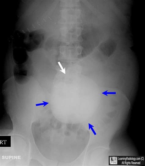 Learning Radiology Incomplete Rim Sign