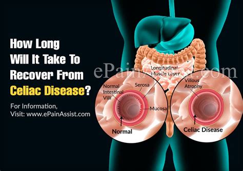 If symptoms are severe, last more than three. How Long Will It Take To Recover From Celiac Disease & How ...