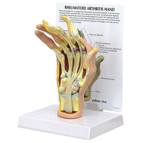 Gpi Anatomicals Rheumatoid Arthritis Ra Hand Model