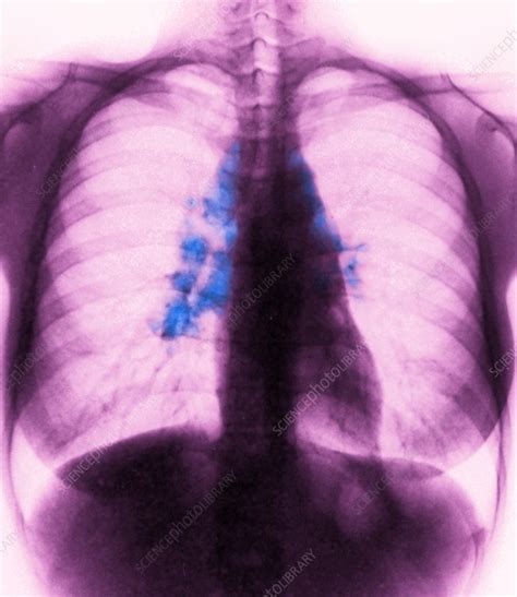 Mediastinal Adenopathy Caused By Sarcoidosis X Ray Stock Image