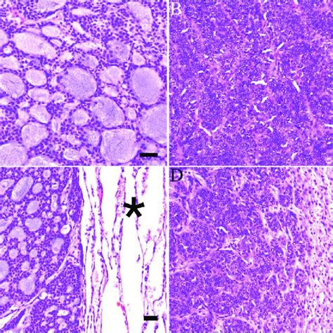 histological features of primary and metastatic salivary gland adenoid download scientific