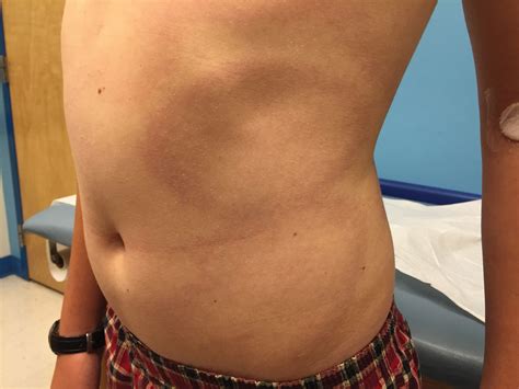 A 13 Year Old Boy Presents With Red Annular Rash On Torso Thighs