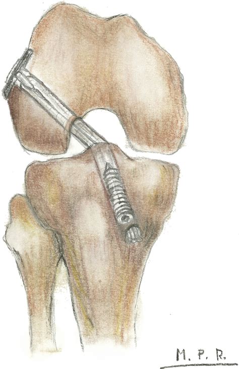 Anatomic Outside In Anterior Cruciate Ligament Reconstruction Using A