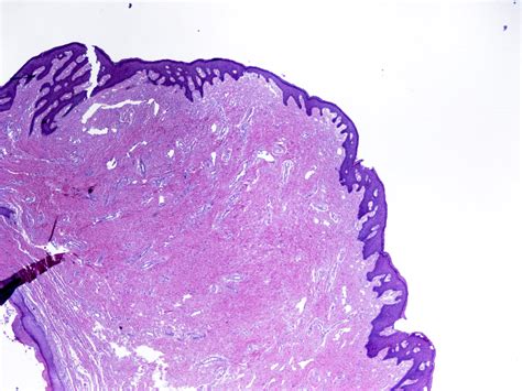 Pathology Outlines Hypertrophied Papillae