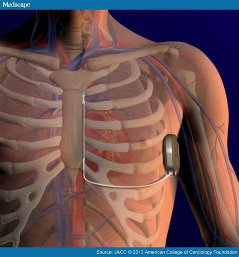 The Subcutaneous Implantable Cardioverter Defibrillator