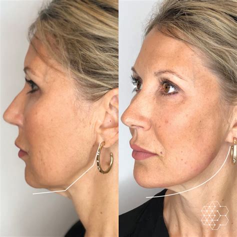 The Best Way To Get Rid Of Jowls Justinboey