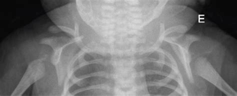 Bilateral Clavicle Fracture A Rare Presentation Of A Common Form Of
