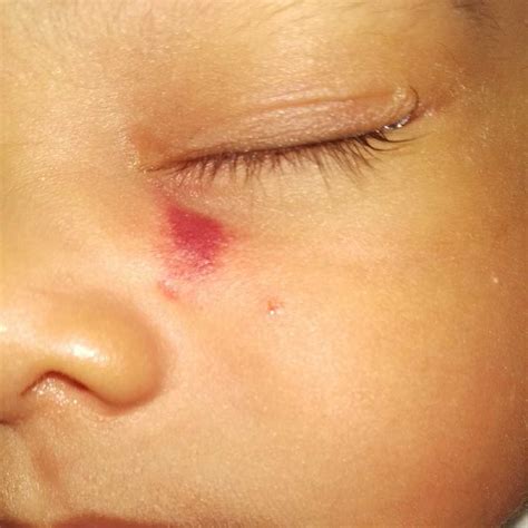 Asktheexpert My Baby Boy Has A Red Spot On Face It Developed After 10