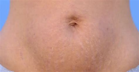 How To Get Rid Of Stretch Marks After Weight Loss