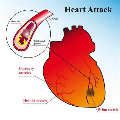 Chest Pain And Heart Attack Here Is What You Do Dr Vivek Baliga