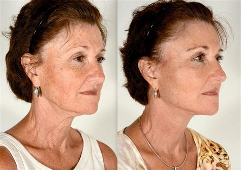 How Long Does A Facelift Last Charleston Facial Plastic Surgery