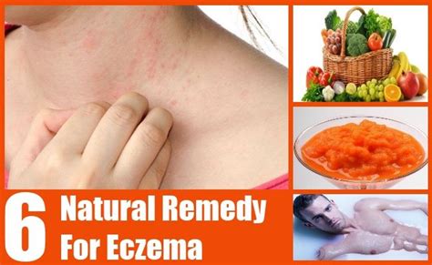 6 Natural Remedy For Eczema Natural Eczema Remedies Eczema Remedies