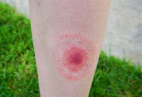 Lyme Disease Symptoms 11 Early Signs And Symptoms Of Lyme Disease