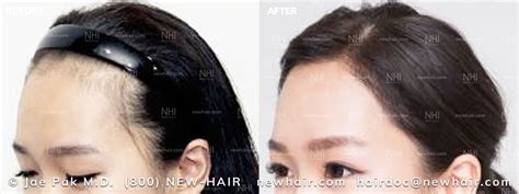 Before And After Forehead Reduction For Women